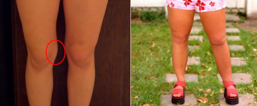 4 причини жиру на колінах