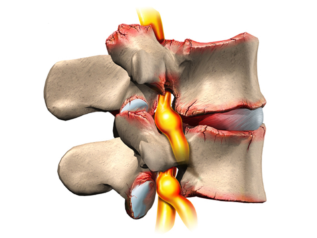Наприклад, міжхребцева грижа у шийному відділі хребта викликає головний біль і біль у руках